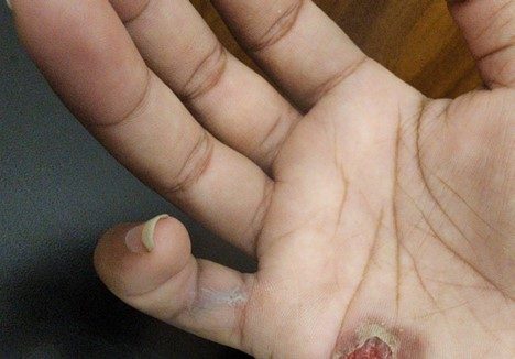 Jeri's pinky is crippled and has blister on her palm 